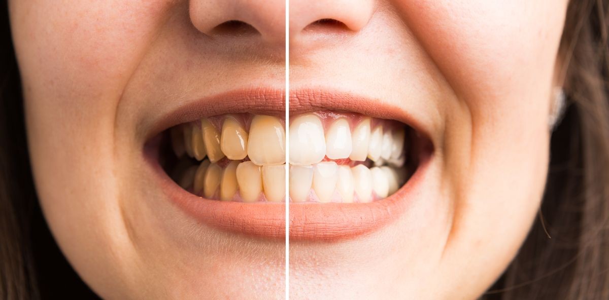 Before and after teeth whitening concept with woman denture yellow and white